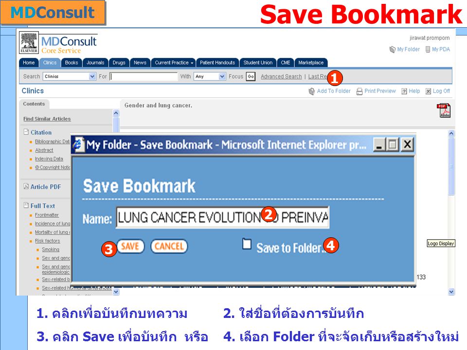 Save Bookmark MDConsult 1. คลิกเพื่อบันทึกบทความ 2.