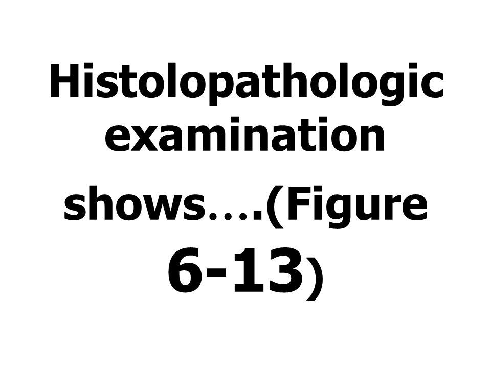 Histolopathologic examination shows ….(Figure 6-13 )