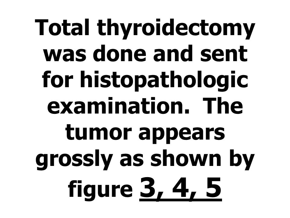 Total thyroidectomy was done and sent for histopathologic examination.